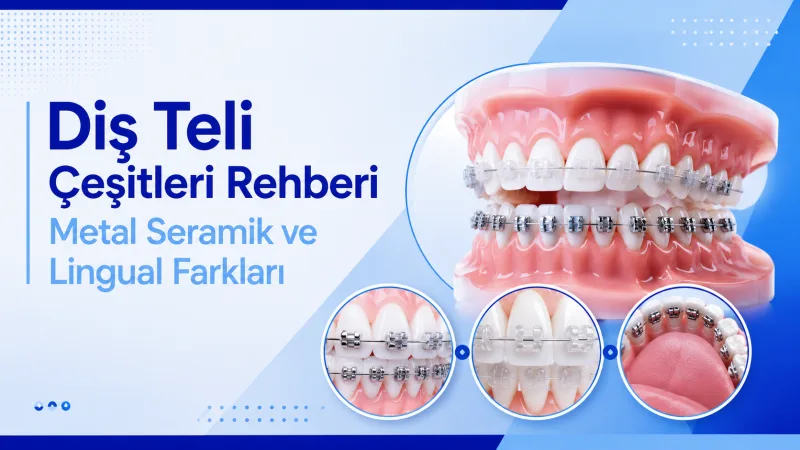 Diş Teli Çeşitleri Rehberi - Metal Seramik ve Lingual Farkları