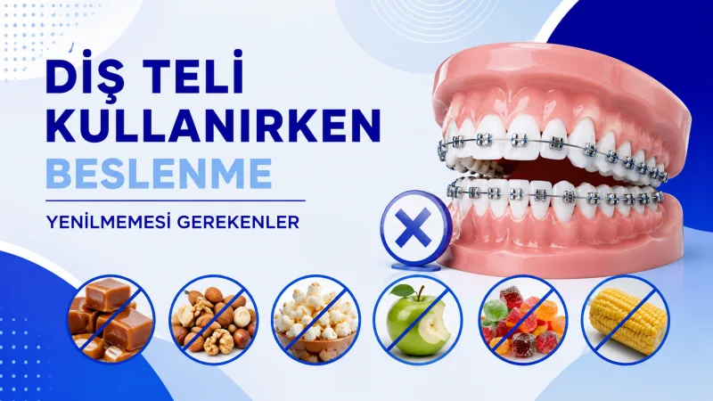 Diş Teli Kullanırken Beslenme - Yenilmemesi Gerekenler